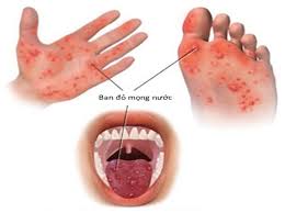 Một số biện pháp phòng chống bệnh tay – chân – miệng tại lớp 4 tuổi C – Trường Mầm non Nghĩa Minh, xã Đồng Thịnh, tỉnh Ninh Bình