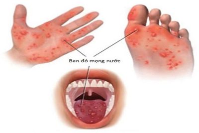 Phòng chống dịch bệnh chân tay miệng – Tháng 4 lớp Nhà trẻ A2