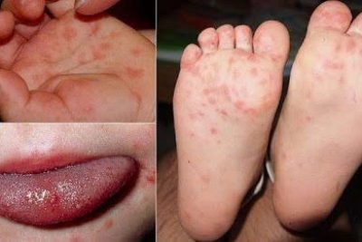 Phòng chống dịch tay chân miệng cho trẻ – lớp 3 tuổi A